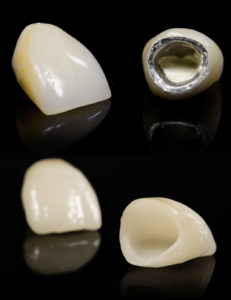 corone dentarie metallo e senza metallo