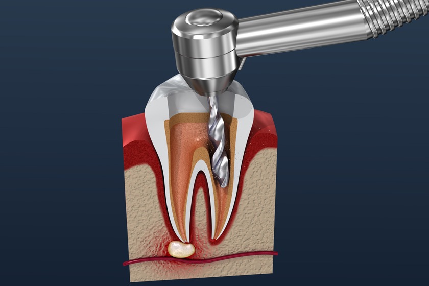 devitalizzazione nervo del dente