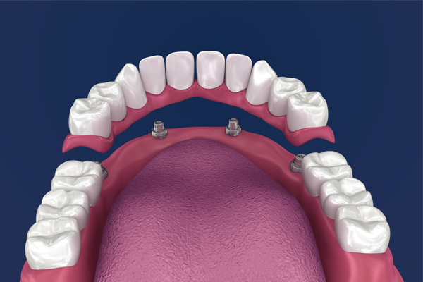 impianto dentale con poco osso