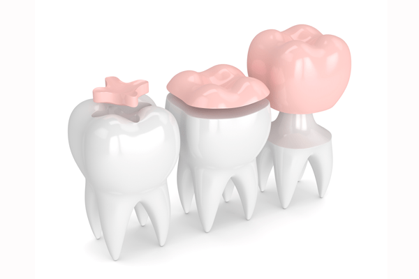 ricostruzione denti