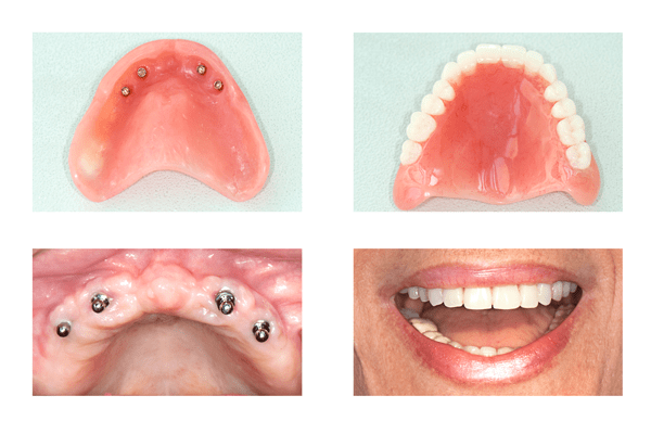 Tipi di impianti dentali