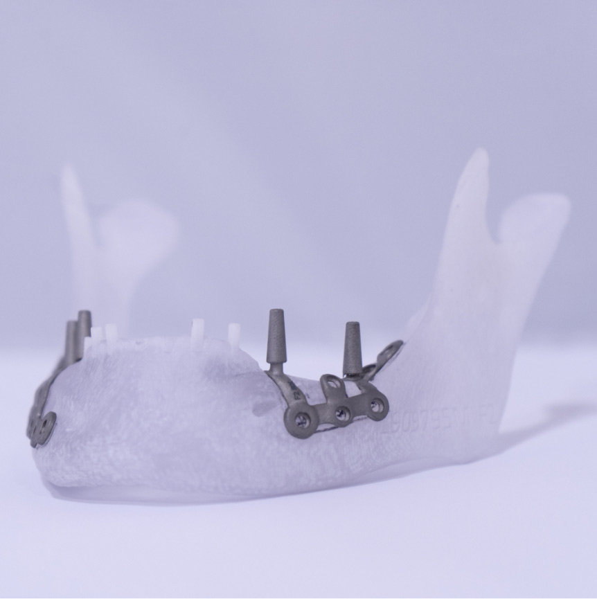 Protesi fissa risolutiva | Eaglegrid | La nuova implantologia dentale universale
